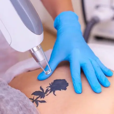 Tattoo-Removal